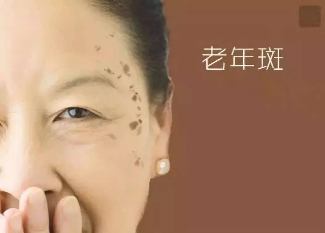 老年斑红霉素可以去除吗,老年斑红霉素