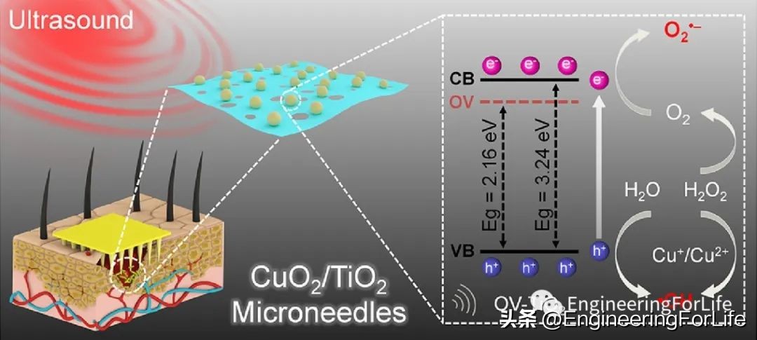 《ActaBiomater.》:超声激活微针用于声温抗菌治疗