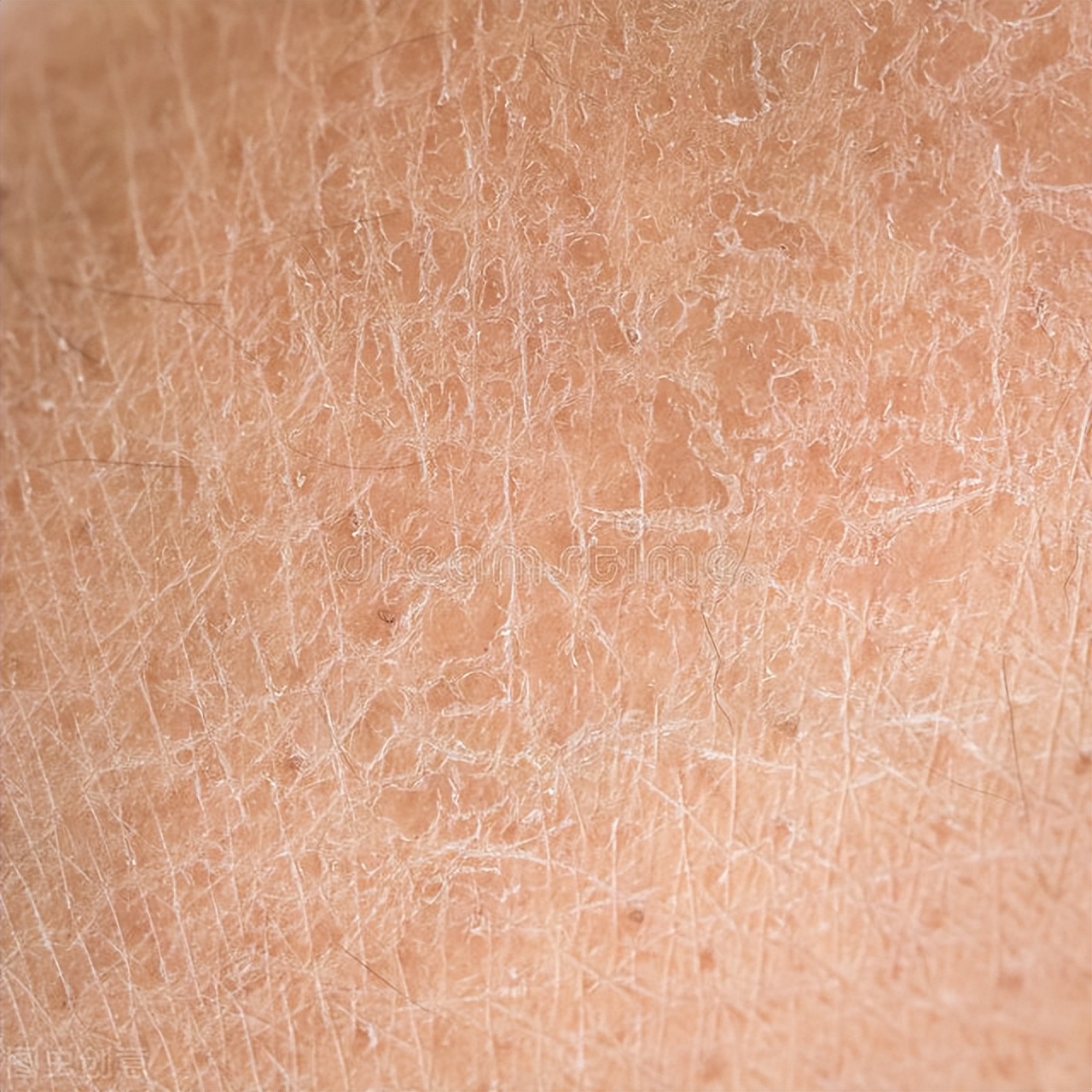 鱼鳞病能彻底治愈吗,鱼鳞病平时注意什么