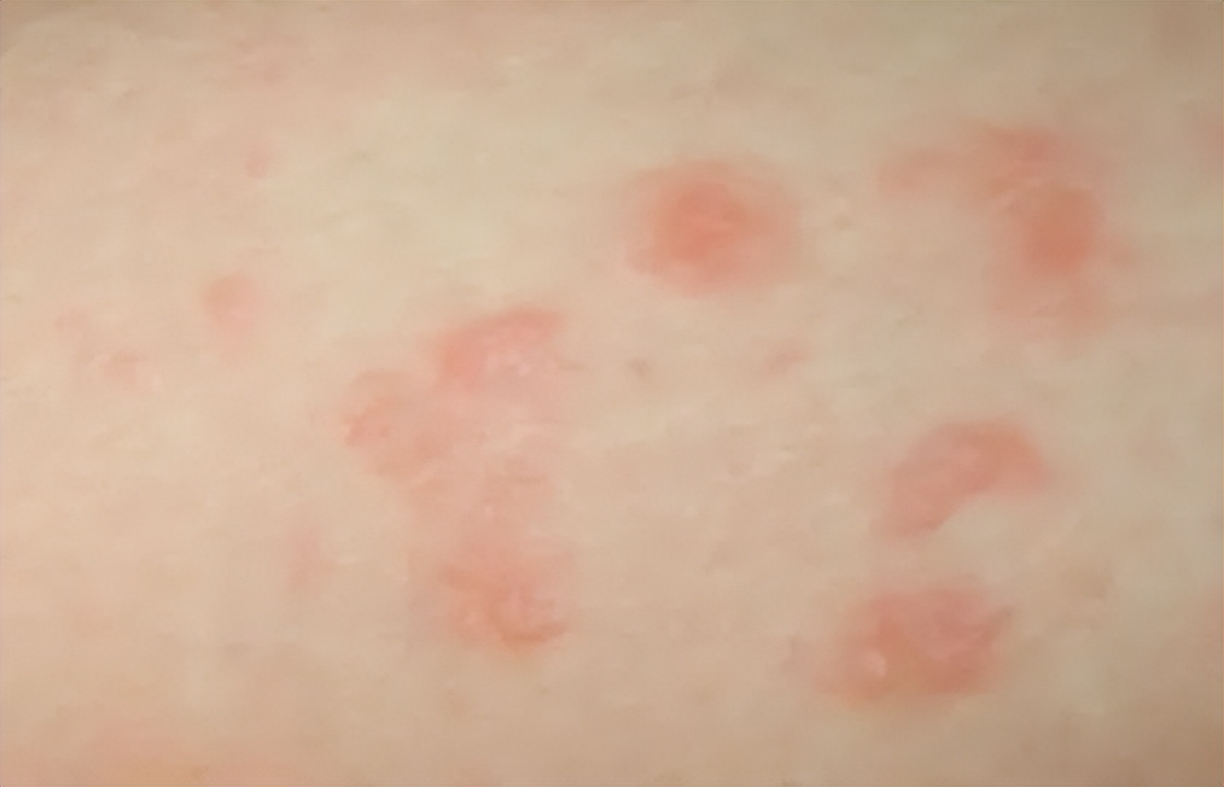 艾滋早期症状会咳痰么,男士艾滋的10个早期症状