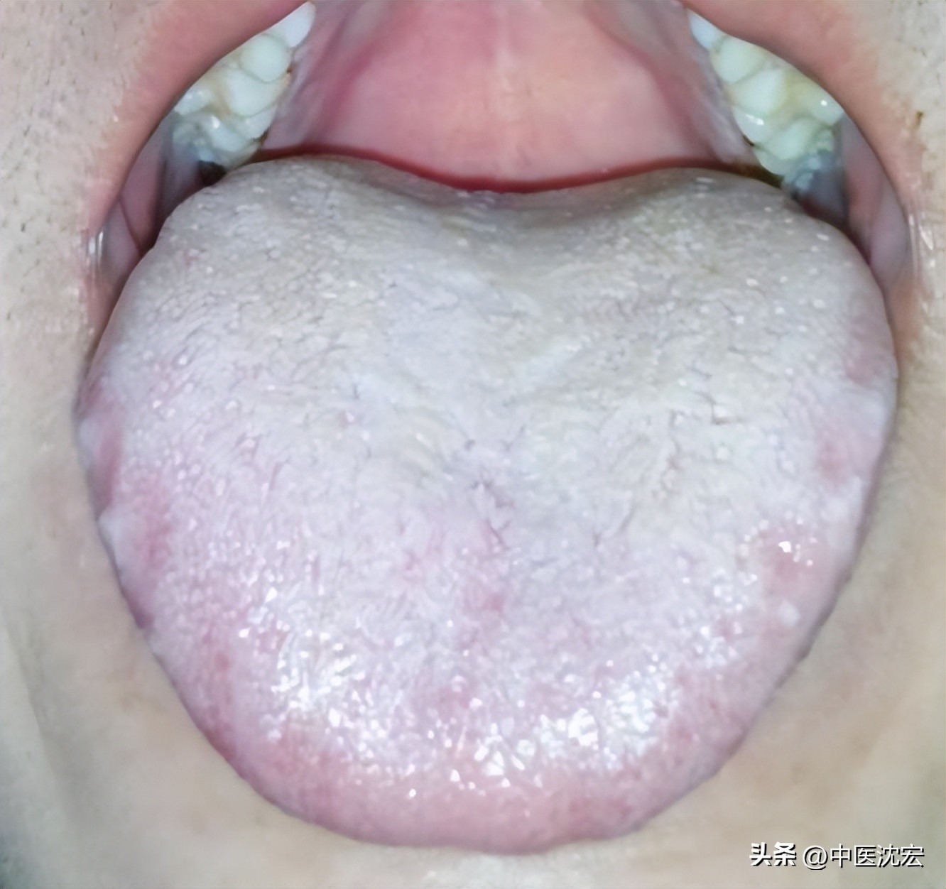 舌苔齿痕特别严重调理的方子,舌苔厚舌边缘有齿痕怎么治疗