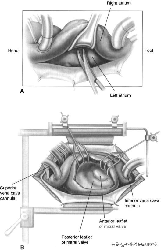 二尖瓣成形术,二尖瓣成形术后需要静养多久
