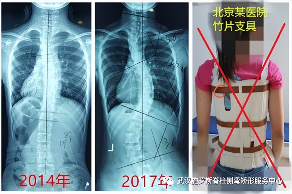 脊柱侧弯矫正支具不调整会怎样,简单辨别脊柱侧弯避免孩子走弯路