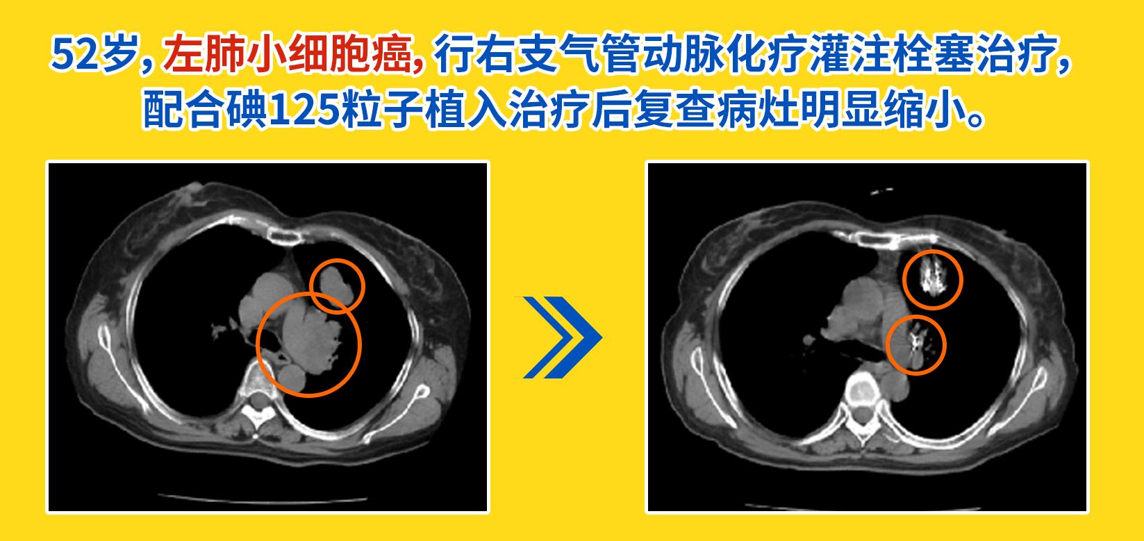 粒子植入术：一根针“排兵布阵”，精准剿灭癌细胞
