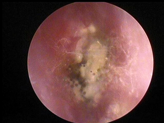 耳朵里面发霉长毛要清除吗,耳朵里长毛发霉了