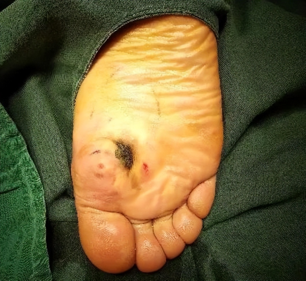 女38岁最近发现脚上长了痣,脚底长了颗痣是癌症吗