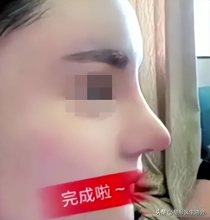 为什么用耳软骨垫鼻头,耳软骨垫鼻尖为什么越来越大