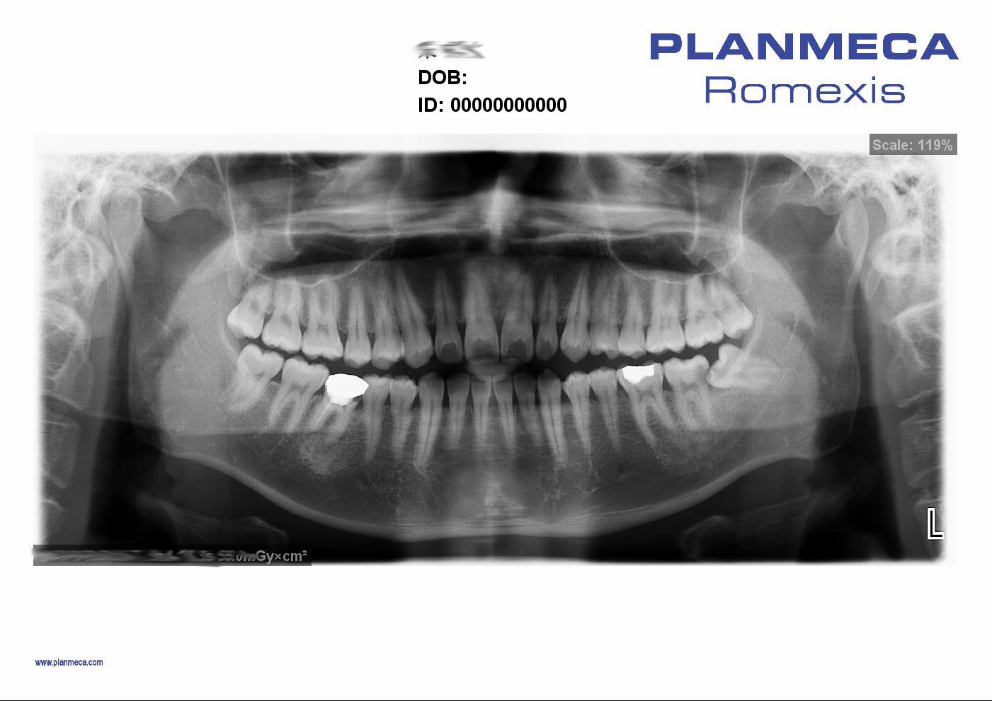 芬兰普兰梅卡全景机,普兰梅卡全景机维修教程
