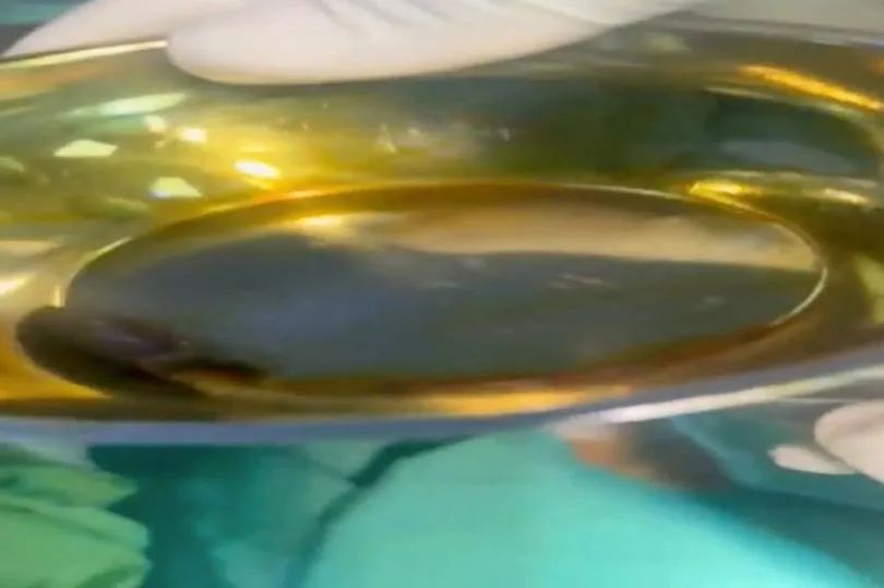 24岁女子意外被*弹子**击中，并卡在阴部，为医疗史上的首次记录