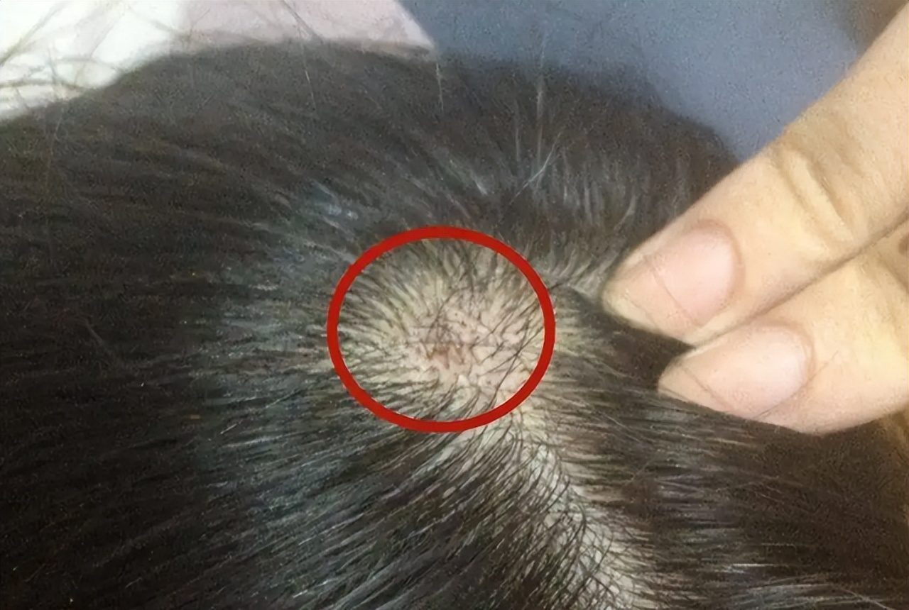 如何改善头皮长脓包和疙瘩的问题,头皮上总是长疙瘩和脓包如何根治