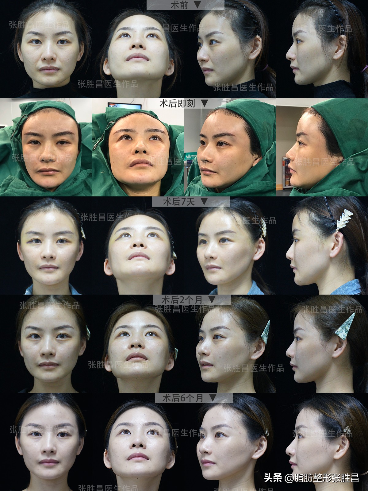 第一次做手术的人心里有点怕,第一次做脂肪填充效果