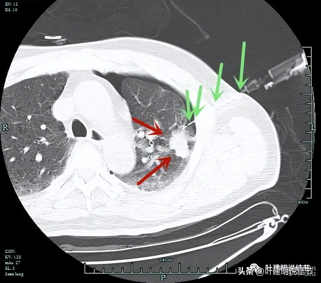 pet判断淋巴结转移,petct判断癌有没有转移准确吗
