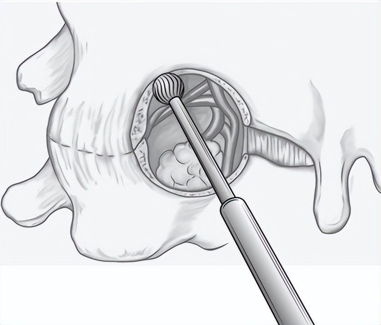 西安椎间孔镜手术治疗颈椎,西安红会医院微创