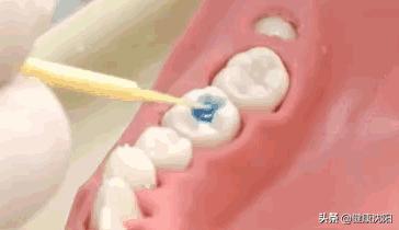 儿童和青少年龋齿的问题如何治疗,低龄儿童龋齿治疗方法