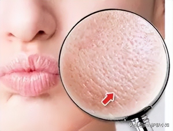 毛孔粗大收缩毛孔做什么医美项目,医美收缩毛孔能达到什么效果