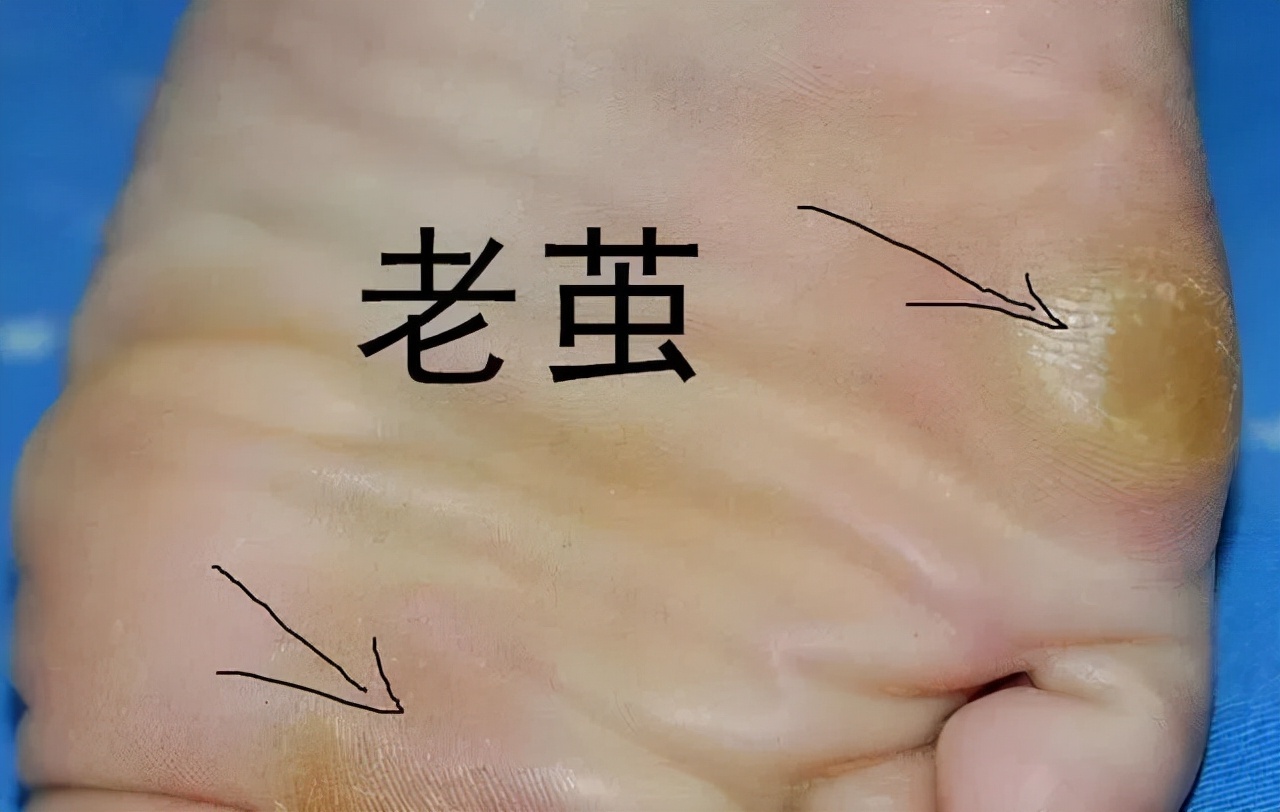 脚底长鸡眼怎么治疗能除根,长了鸡眼怎么治疗好得快