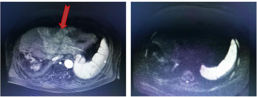 放疗肝内胆管细胞癌能治好吗,放疗治疗肝门静脉癌栓