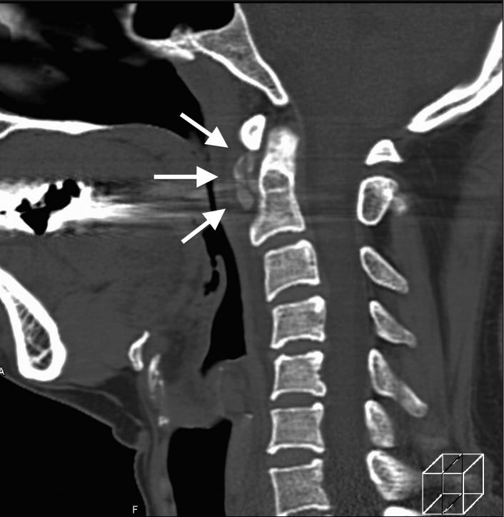 颈长肌腱炎影像表现,三头肌钙化性肌腱炎治疗