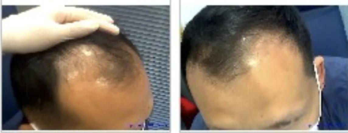 雄脱植发的亲身经历和感受,16000字讲述植发真实感受