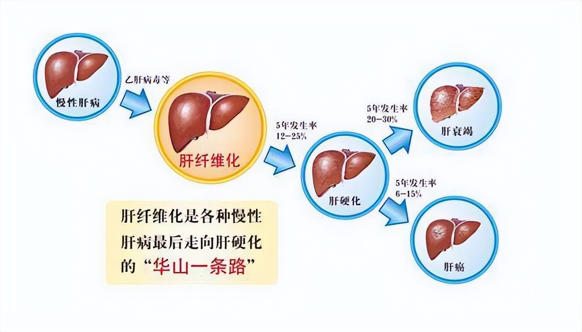 肝癌怎么治疗比较好呢,肝癌中西医结合有用吗