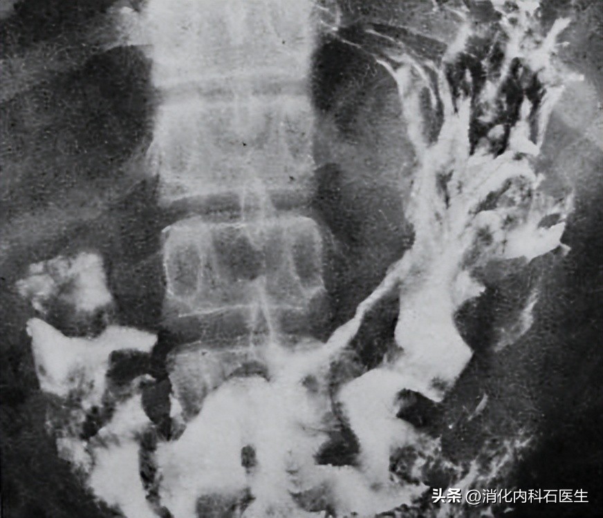 女子突发腹痛，喝可乐治疗无效，医生无奈剖腹：血管被栓了