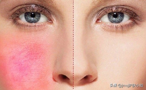 脸部红血丝怎么消除小窍门,脸部红血丝怎么去除最有效