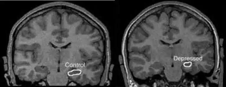 得了抑郁症，长期不治疗会发生什么？