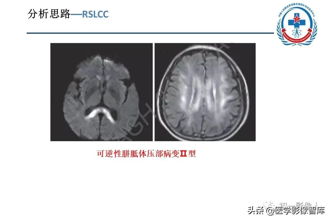 胼胝体变性治疗方法,原发性胼胝体病变治疗