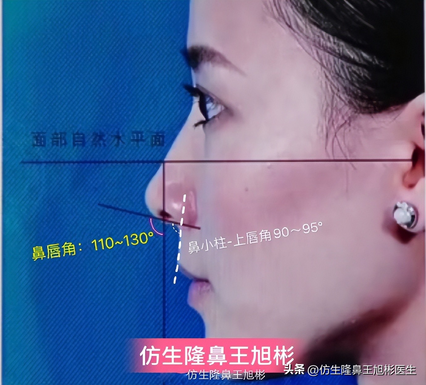 窄鼻子如何通过鼻整形来矫正,宽鼻子矫正方法