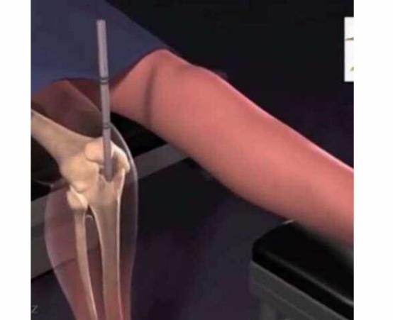 李亚诺断骨手术,断骨增高7.2厘米的李亚诺现状