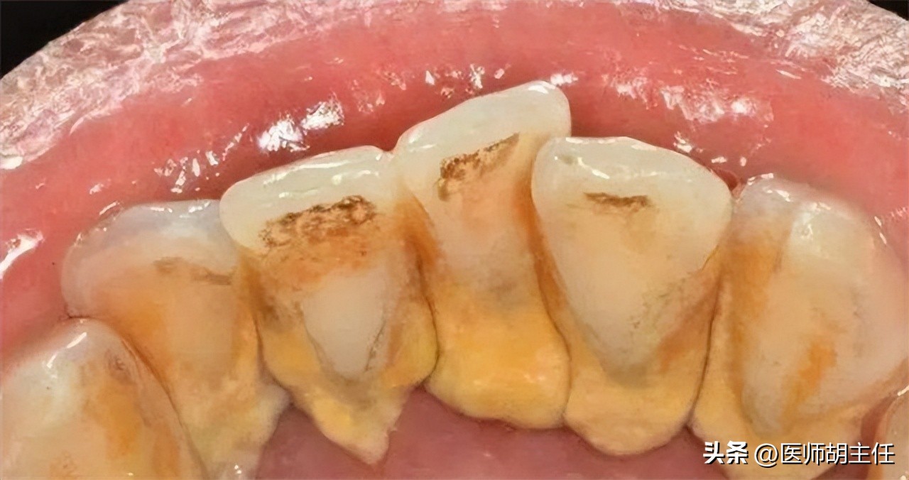 牙缝中的牙结石怎么去除,牙缝的牙结石怎么自己去除