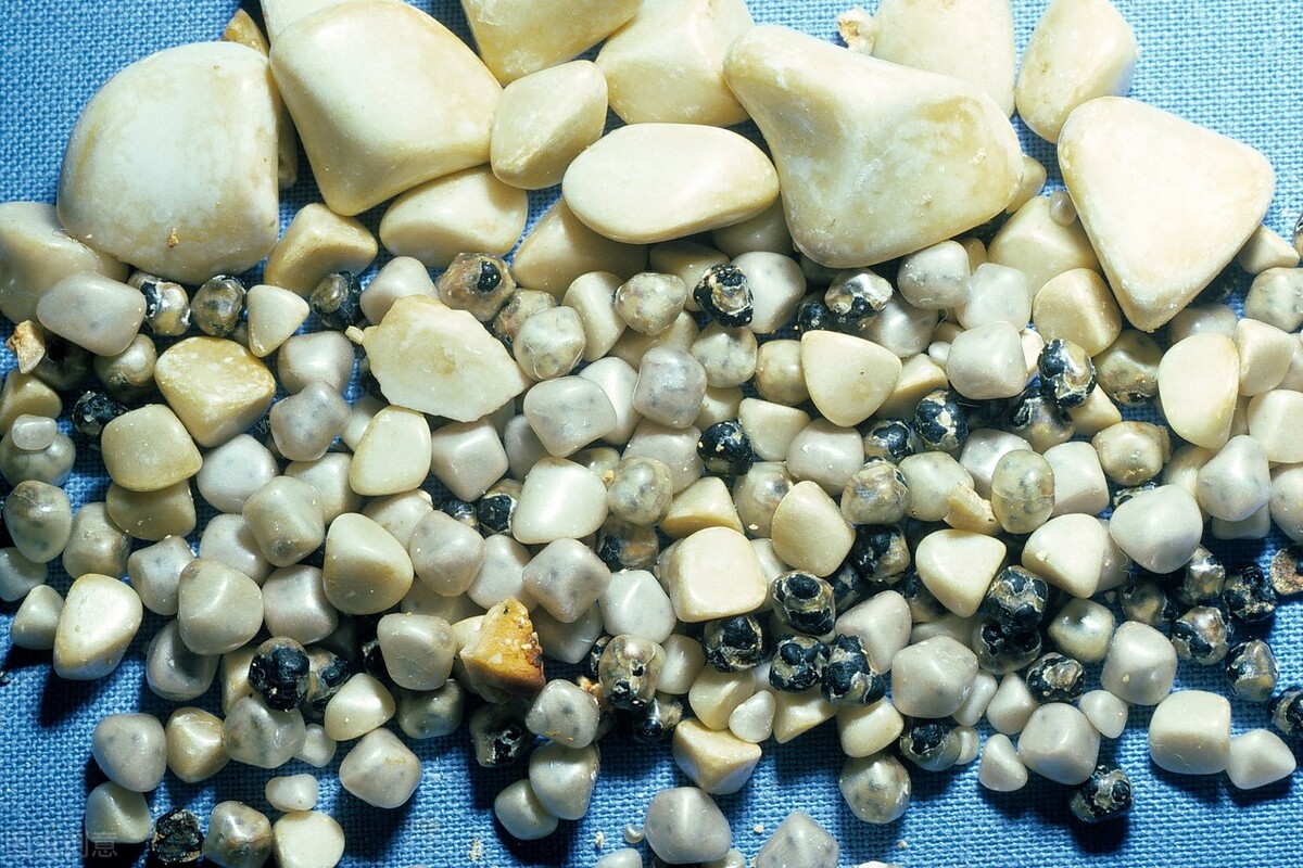 三金排石汤老中医治胆结石方子,治胆结石老中医方剂