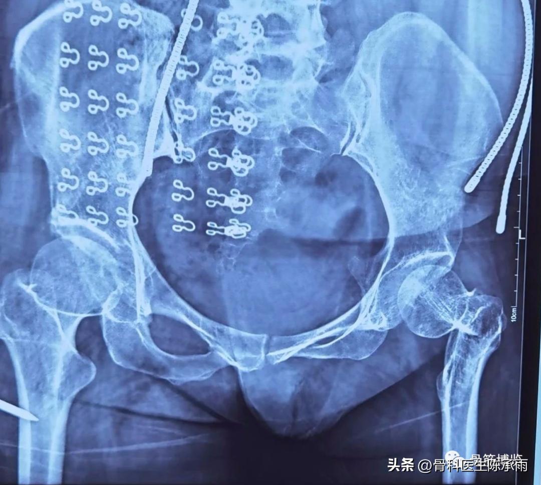 股骨颈闭合复位内固定术后护理,股骨颈骨折闭合复位的技巧