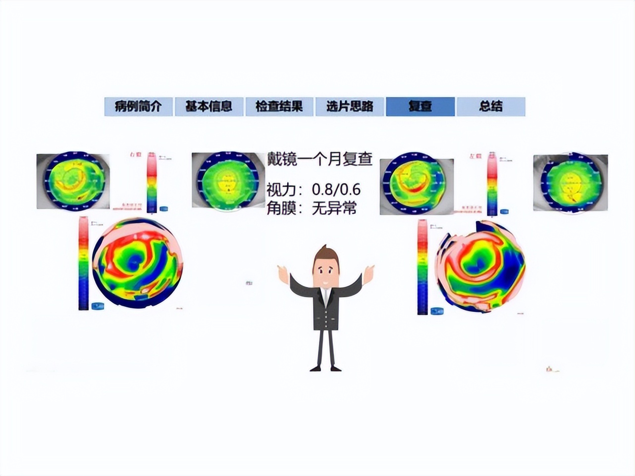 王凯角膜塑形镜原理,王凯医生塑形镜