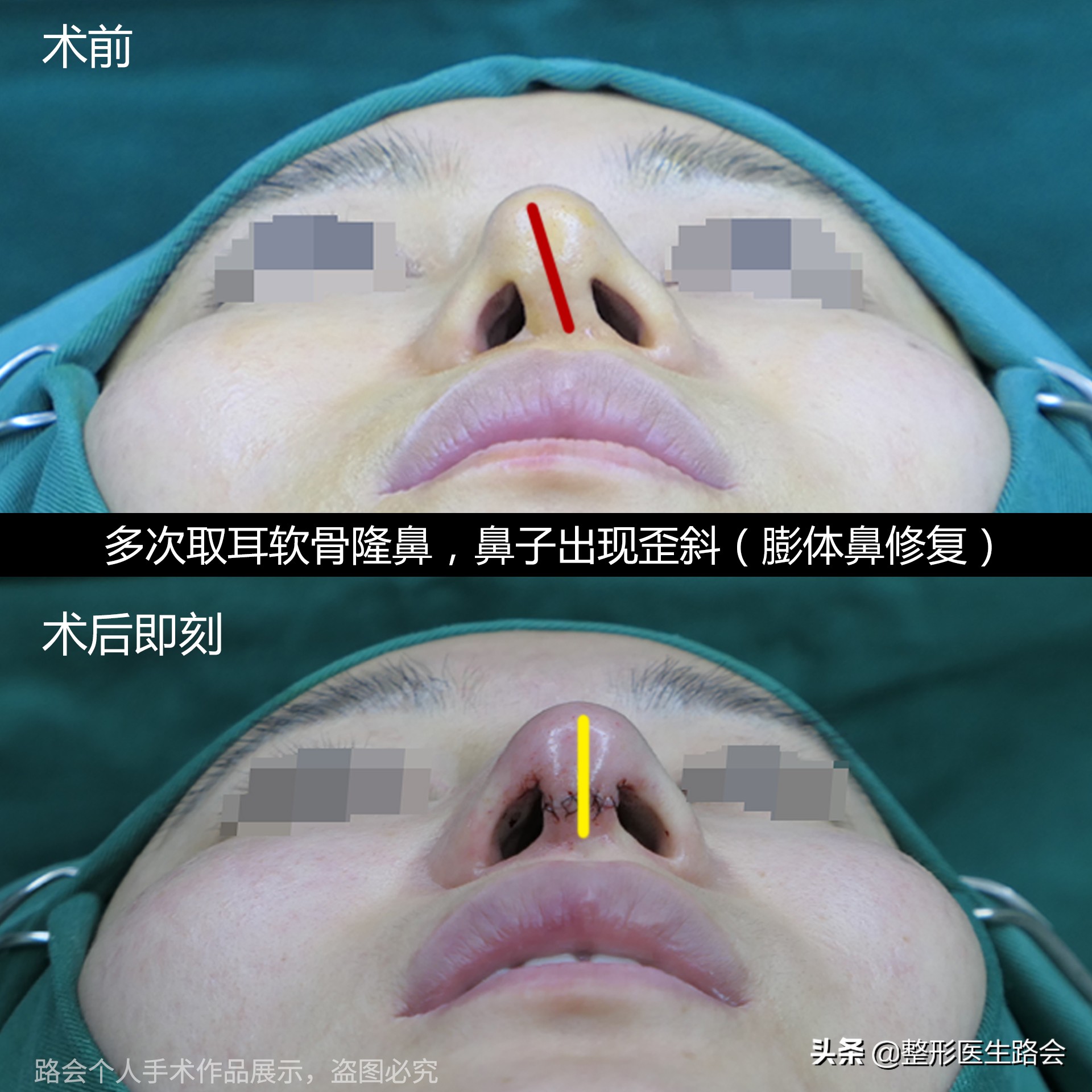 为什么隆鼻很久了鼻子还会歪,隆鼻了怎么确定鼻型歪不歪