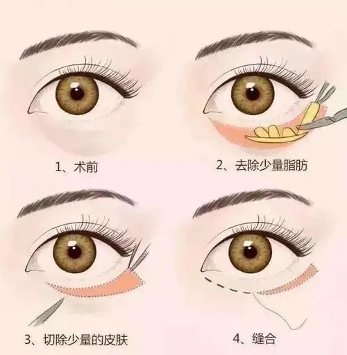 眼袋大怎么办如何解决快又好,眼袋大很显老小妙招