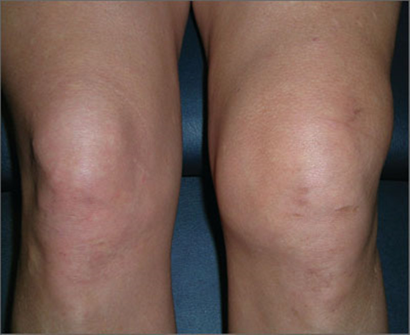 运动膝盖积液最快消除方法,膝盖积液抽了还能运动吗