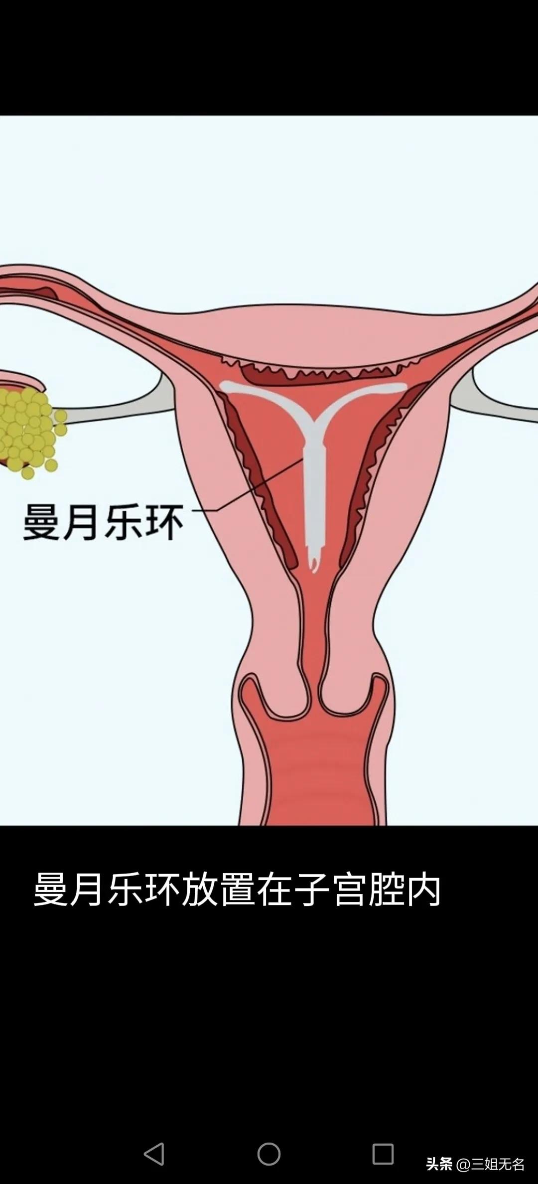长效避孕哪种方法最好,用什么避孕方法最好呢