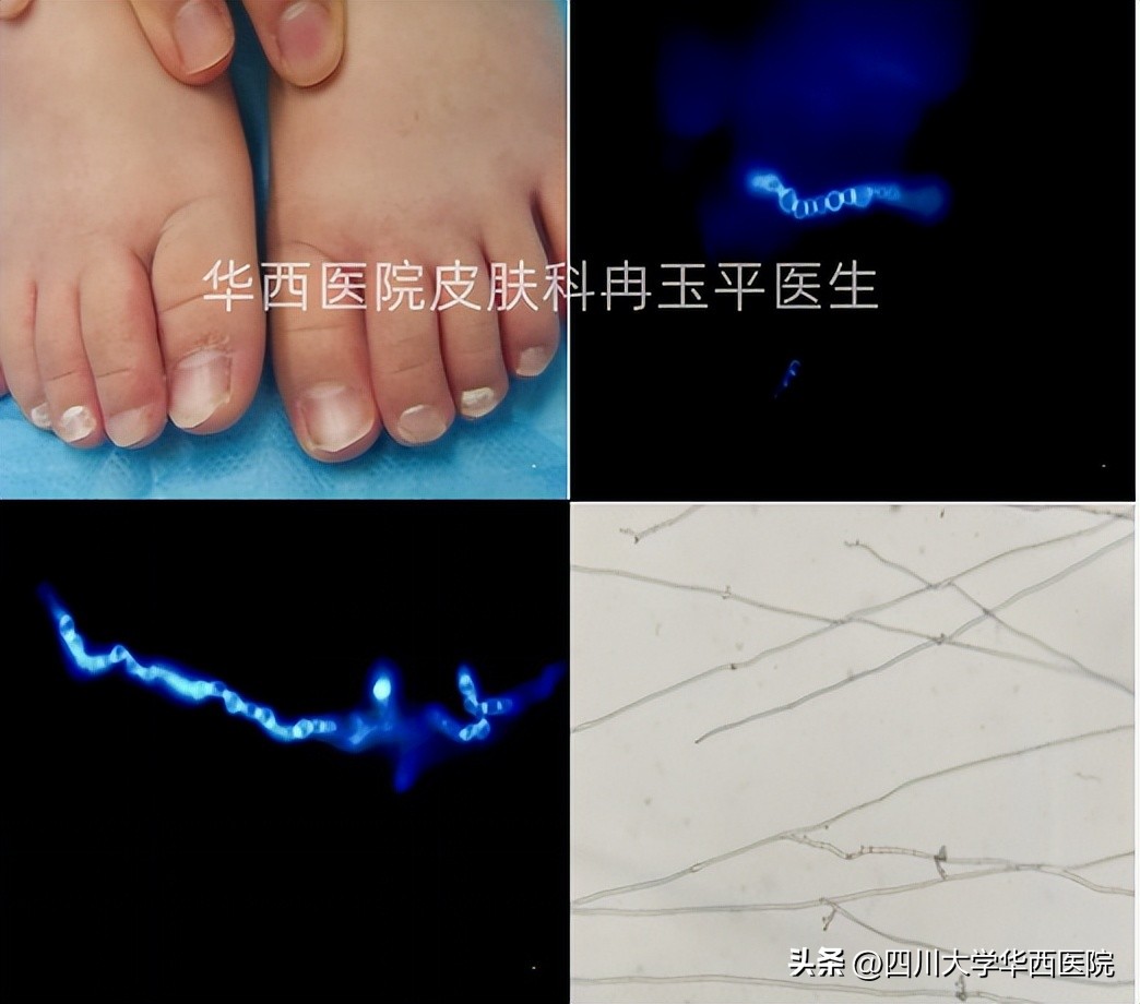 灰指甲到底算什么病,指甲黄是不是灰指甲