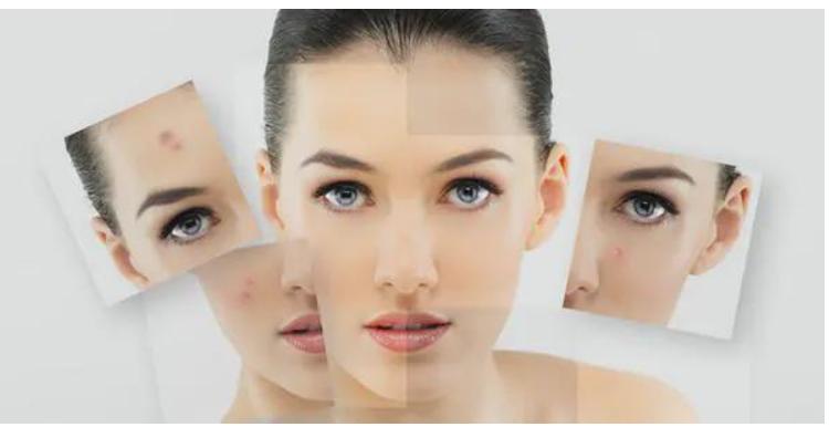 如何有效改善红痘印和黑痘印,白痘印和黑痘印哪个更容易遮盖