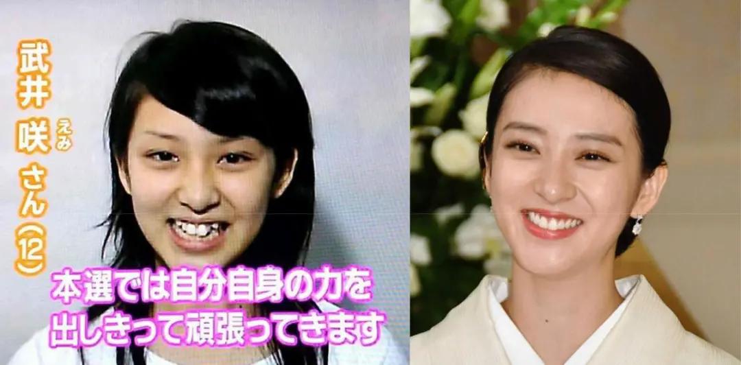 日本整牙的明星,日本整牙明星