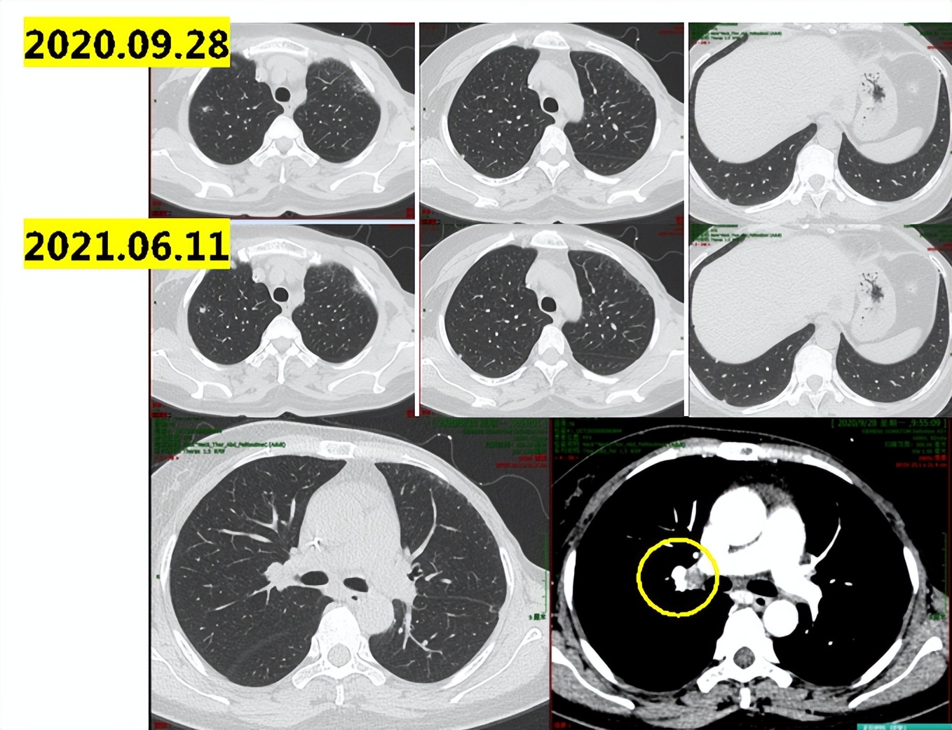 乳腺癌晚期没多少钱怎么治疗最佳,经济困难癌症晚期可以放弃治疗吗