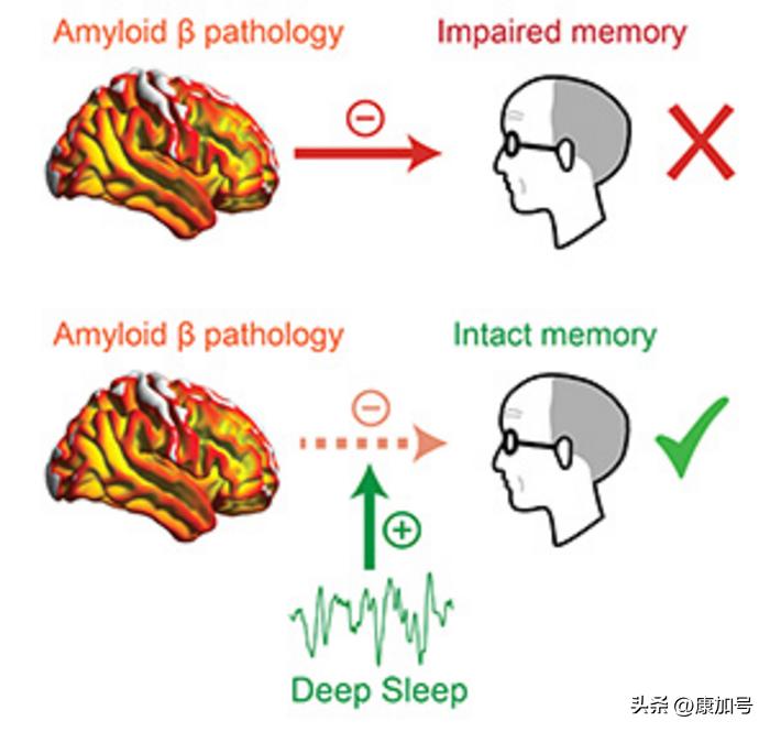阿尔茨海默症与睡眠有关,良好睡眠可降低阿尔茨海默病风险