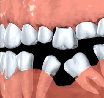 松动的智齿自己拔好还是医生拔好,松动的牙固定还是种牙好