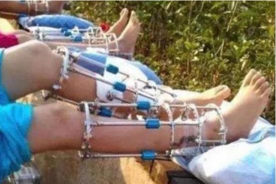 李亚诺断骨手术,断骨增高7.2厘米的李亚诺现状