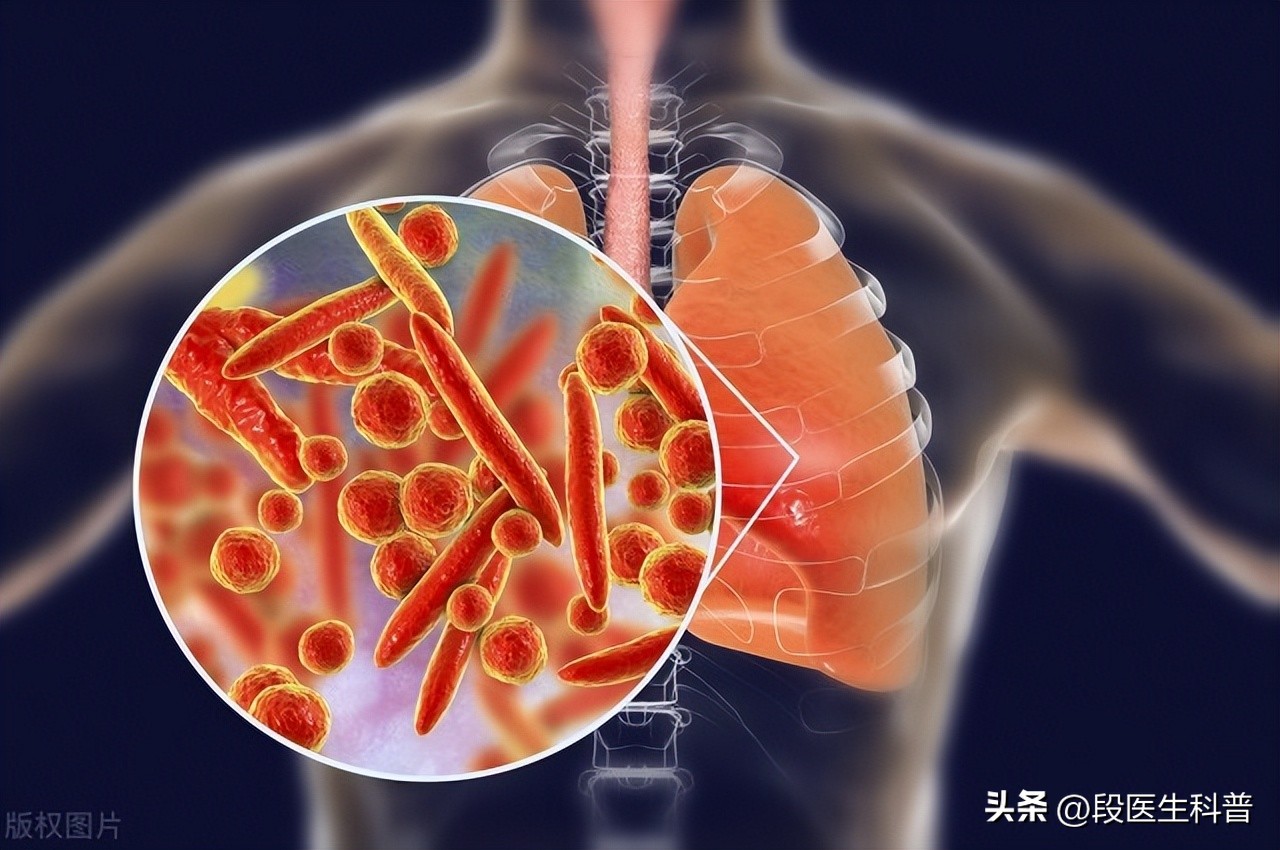 肺炎危害程度有多大,肺炎一般需要多久才能彻底治愈