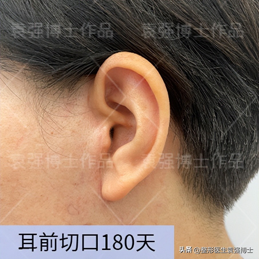 拉皮手术后疤痕怎么修复,拉皮手术后有疤痕能恢复吗