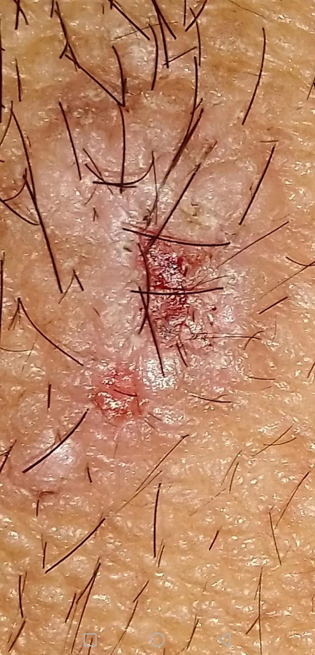 牛皮癣伴随一生是怎么样的体验,对抗牛皮癣一直在坚持