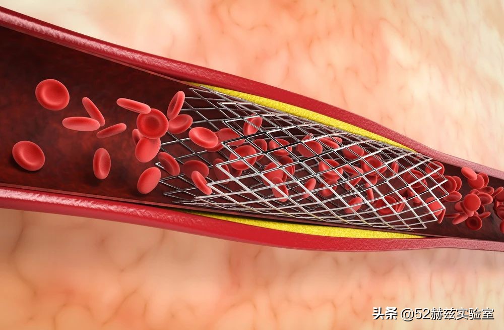 从13000元骤降至700元！看国产心脏支架如何吊打国外？