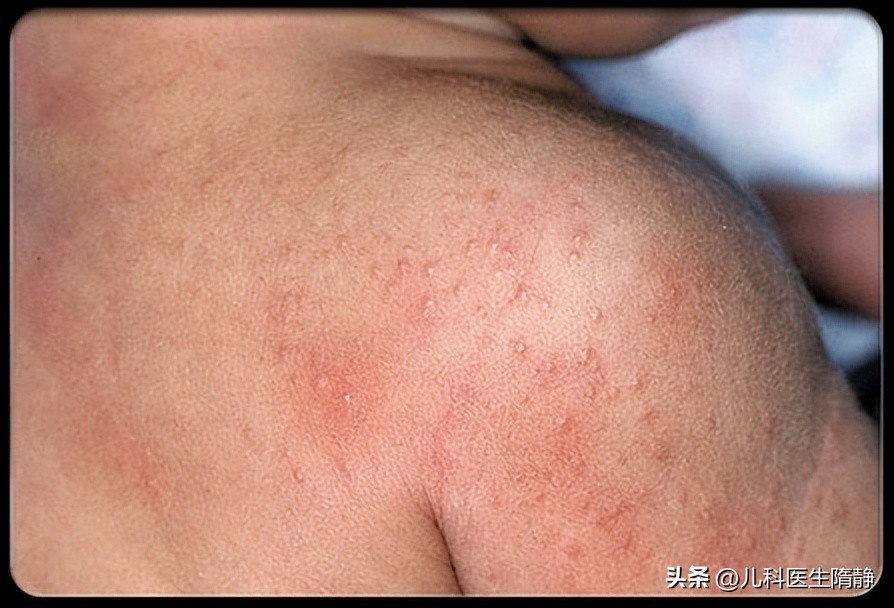 家有湿疹宝宝的看过来,家有过敏宝宝终于好了说说